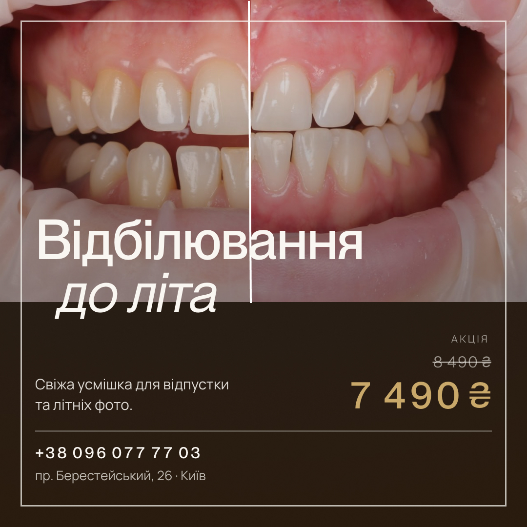 Відбілювання до літа у Seven Dent